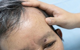 Người đàn ông ở Đà Nẵng bị ong đốt đến hôn mê, suýt chết
