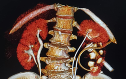 Hi hữu: Ra Hà Nội khám bệnh, người phụ nữ tình cờ phát hiện đã "chung sống" với 4 QUẢ THẬN trong suốt 65 năm