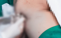 Tiêm 1.000ml filler giả vào mông, cô gái nhập viện hút ra 3.000ml dịch hoại tử