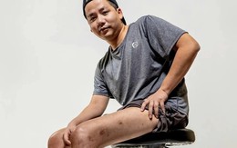 Khoa Pug Chi 3 tỷ để cao thêm 7 cm: Bác sĩ nói gì?