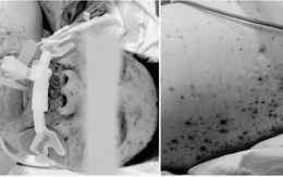 Người đàn ông suy gan tối cấp, suy đa tạng nguy kịch vì biến chứng thủy đậu