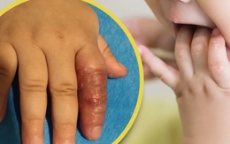 Mẹ dùng băng quấn để ngăn con mút tay, em bé suýt phải cắt cụt ngón