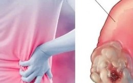 Dấu hiệu âm thầm của ung thư thận dễ bị bỏ qua