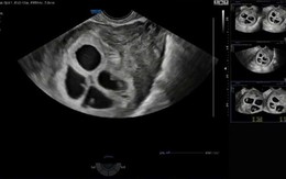 Cực hiếm gặp: Bệnh viện Phụ Sản Hà Nội ghi nhận 1 sản phụ mang thai 4 tự nhiên, tỷ lệ chỉ khoảng 1/700.000 - 800.000 ca