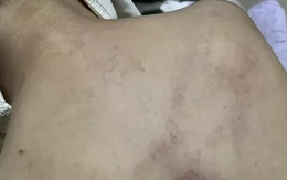 Bé mẫu giáo bị đánh tím lưng, clip từ camera khiến phụ huynh bàng hoàng