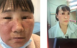 Người phụ nữ cấp cứu với khuôn mặt biến dạng: Bác sĩ thốt lên "tuyệt đối đừng dùng thứ này"