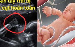Thai nhi 21 tuần bị cắt cụt các ngón tay vì một thứ "sắc hơn dao" ngay trong bụng mẹ: Nguy hiểm nhưng khó phát
