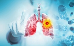 Vợ bất ngờ phát hiện ung thư giai đoạn cuối, nguyên nhân tới từ 1 thói quen của chồng