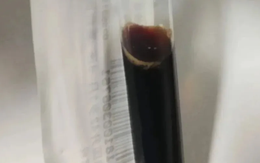 Chàng trai 25 tuổi cấp cứu vì "nước tiểu chuyển màu đen kịt"