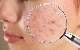 Ăn càng nhiều 5 thực phẩm này, đừng hỏi vì sao mụn "đua nhau" tìm đến
