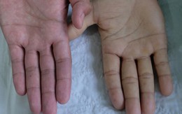 Một bệnh lý nguy hểm không chừa một ai: từ trẻ em, phụ nữ đến người làm văn phòng!