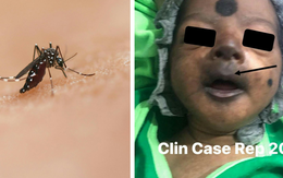 Bé trai 12 ngày tuổi mặt tím đen vì nhiễm virus Chikungunya có thể "phá hủy nội tạng"