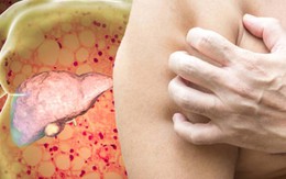 5 dấu hiệu trên da cảnh báo gan đang suy hỏng giai đoạn đầu: Có 1 cũng đừng bỏ qua!
