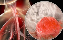 Nam giám đốc bất ngờ phát hiện ung thư giai đoạn 3: Hối hận vì đã bỏ qua 1 dấu hiệu suốt nhiều năm