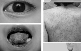 Trẻ mắc bệnh hiếm gặp gây đột tử, bác sĩ chẩn đoán bị... viêm họng