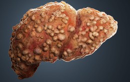 Cảnh báo cho những ai đang ăn kiểu này, nguy cơ xơ hóa gan tăng 61%: Nghiên cứu đã chứng minh