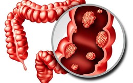5 triệu chứng "không đau" của ung thư đại tràng: Người trẻ càng phải chú ý