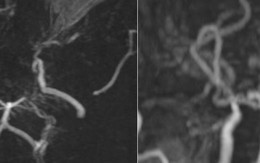 Hình ảnh MRI khiến bác sĩ bất ngờ: Mạch máu não bệnh nhân mờ như "khói thuốc"