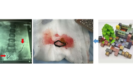 Ớn lạnh phát hiện 20 viên nam châm rỉ sét nằm trong bụng bé trai