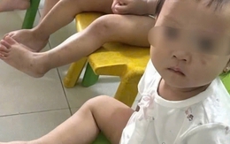 Tình trạng sức khỏe bé gái 1 tuổi bị bầm tím mặt khi gửi nhà trẻ ở Bắc Ninh