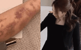 Sao nữ xinh như tiên tỉnh dậy hoảng loạn thấy toàn thân bầm tím sau khi tiêm thuốc bổ tại bệnh viện