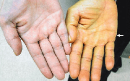 Siêu âm phát hiện nhiều người trẻ gan thô xù xì, nguyên nhân vì đâu?