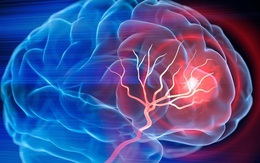 Mỹ phát triển phương pháp trị đột quỵ mới, chỉ cần 1 lần truyền dịch