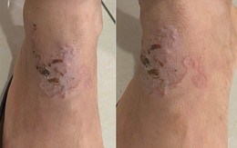 Sinh vật "đào đường hầm" ngoằn ngoèo dưới da người phụ nữ: Bác sĩ chỉ đích danh thủ phạm