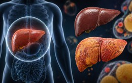 1 loại thực phẩm có thể hại gan hơn cả rượu bia nếu tiêu thụ quá nhiều: Thích đến mấy cũng phải hạn chế