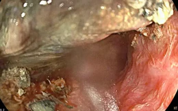 Bé 3 tuổi bị bỏng thực quản vì nuốt pin cúc áo: Cần cảnh giác cao độ