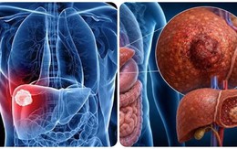 9 triệu chứng ung thư gan giai đoạn đầu