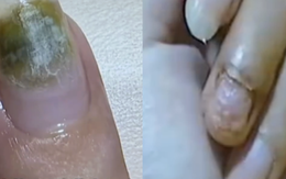 Trung Quốc: Tiệm nail khiến nhiều người nhiễm HPV do khử trùng dụng cụ làm móng qua loa