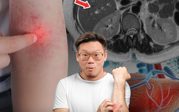 Phó Giám đốc Bệnh viện Thái Lan cảnh báo 4 dấu hiệu trên da là "lời kêu cứu" của gan, nhiều người bỏ qua rồi hối hận không kịp