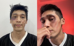 Nam ca sĩ Việt mặt mũi bầm dập vì xin vợ chơi pickleball, chuyện gì đây?