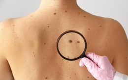 Ung thư da trông như thế nào? Đây là 3 hình ảnh để nhận biết