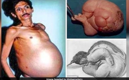 Người đàn ông 60 tuổi "mang thai" suốt 36 năm, nhóm bác sĩ kinh hoàng khi tiến hành phẫu thuật