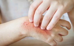 Muốn biết thận khỏe hay không, cứ nhìn vào da sẽ rõ: Đây là 7 dấu hiệu nếu có cần đi khám ngay