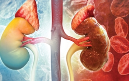 Suy thận có thể tấn công bất ngờ không báo trước: Đây là 4 đối tượng cần đặc biệt cảnh giác
