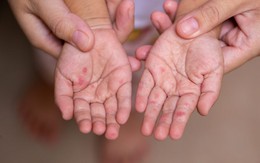 Tác nhân gây ra loạt ca tay chân miệng nặng ở TP.HCM