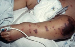 Liên tiếp ghi nhận ca mắc não mô cầu, nhận diện sớm dấu hiệu điển hình