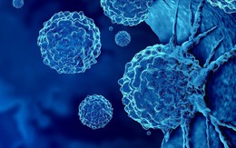 Loại ung thư đứng thứ 2 về tỉ lệ tử vong tại Việt Nam: 5 dấu hiệu sớm nhất ai cũng nên biết