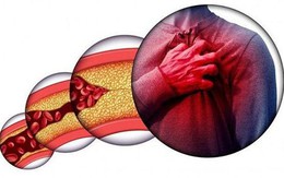 Gầy nhưng mỡ máu vẫn cao vút: Không hề vô lý, "thủ phạm" chính là đây