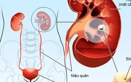 Cách phòng ngừa sỏi thận không dùng thuốc