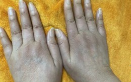 Nữ doanh nhân có 1 dấu hiệu lạ ở tay nhiều năm: Đi khám bác sĩ cảnh báo hàng loạt tạng đang "gặp nguy"