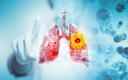3 tín hiệu là "cảnh báo đỏ" của ung thư phổi: Sau 40 tuổi càng phải chú ý