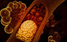 Ăn nhiều rau luộc, ít thịt cả 3 bữa trong ngày nhưng mỡ máu vẫn cao vút: Bất ngờ với "thủ phạm"