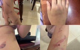 Xác minh vụ bé gái 9 tuổi có 34 vết bầm nghi bị bạo hành ở Đắk Lắk