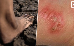 Thái Lan cảnh báo khẩn về dịch "sốt đất": 732 ca nhiễm, 23 trường hợp tử vong