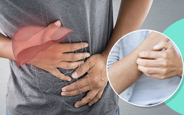 Không phải dị ứng: 2 DẤU HIỆU cơ thể đang “kêu cứu” vì ung thư gan, nhiều người Việt vẫn chủ quan