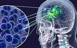 Cà Mau cập nhật thông tin vụ 2 ca não mô cầu